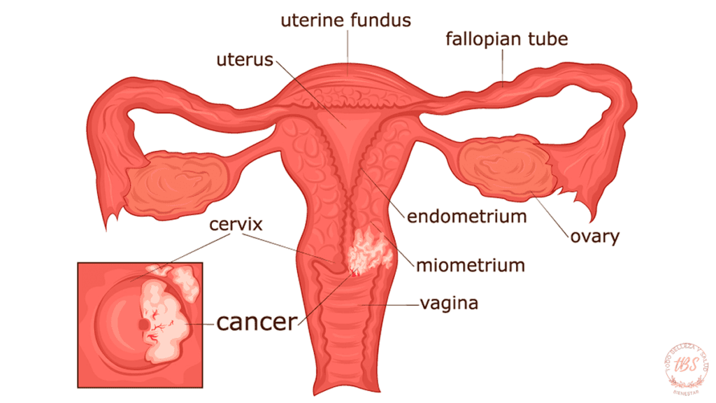 Cáncer de cuello uterino Qué es y cómo prevenirlo