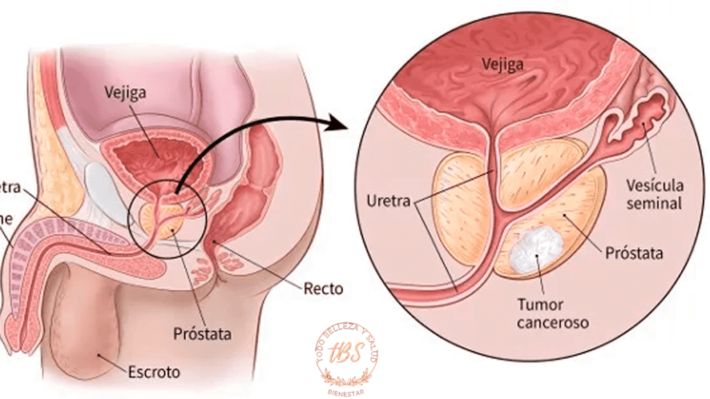 Cáncer de próstata Lo que necesitas saber