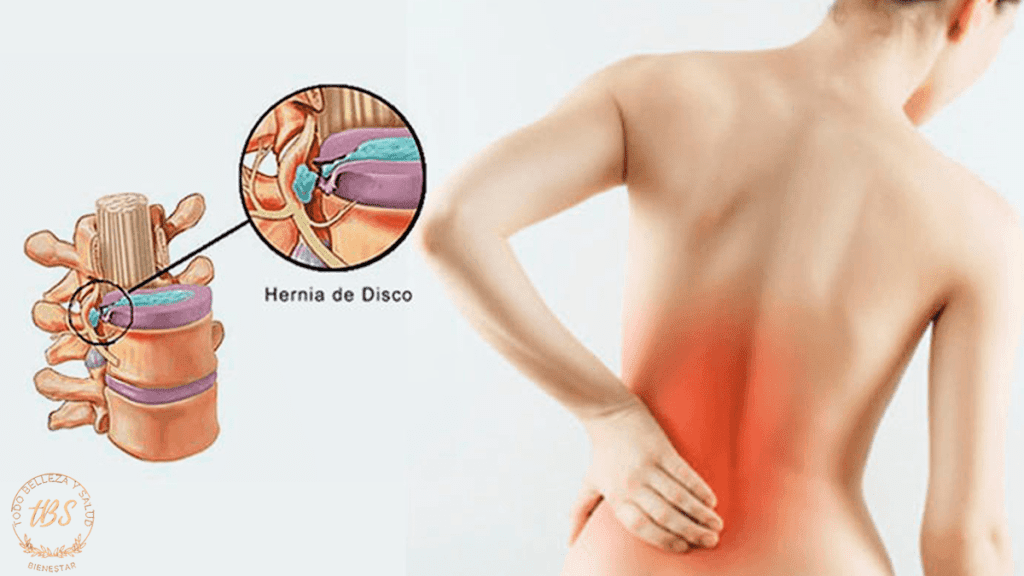 Hernias en la Columna Qué Son y Cómo Se Manejan