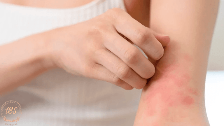 Qué es la Dermatitis