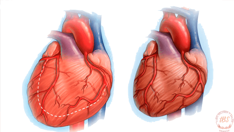 Insuficiencia cardíaca: Qué es y cómo afecta al corazón