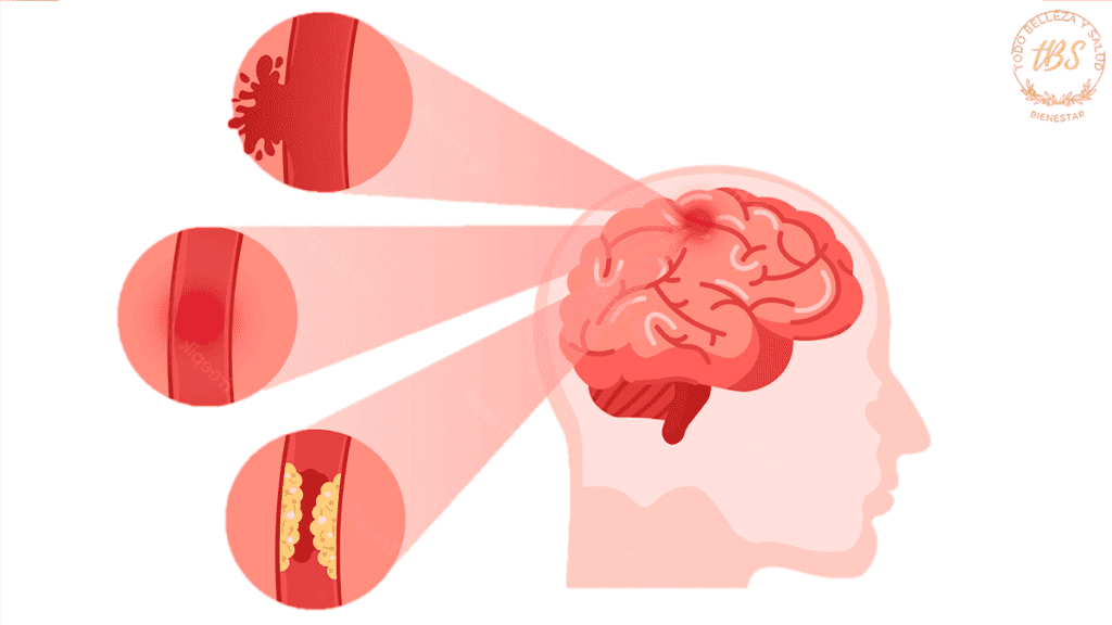 ¿Qué es un accidente cerebrovascular (ACV)?