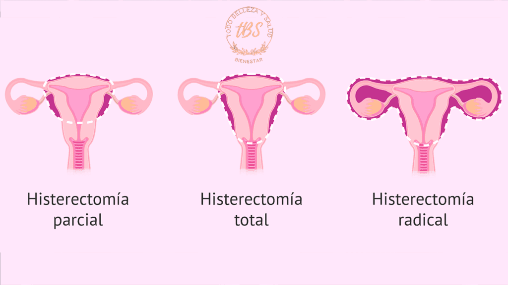 Qué es una Histerectomía