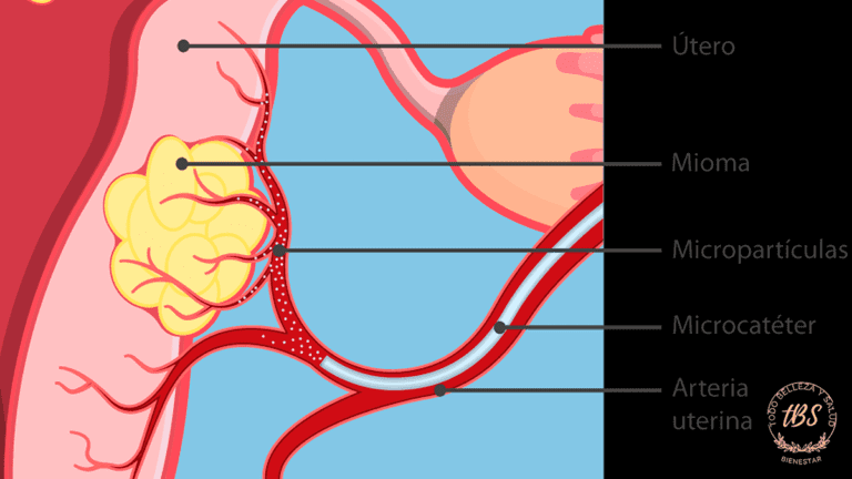 Qué es una embolización de miomas