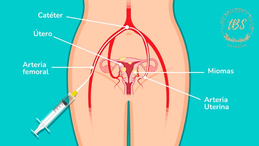 Qué es una embolización de miomas