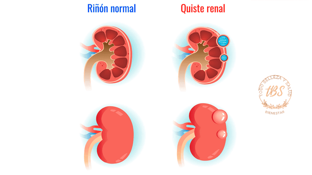 Qué son los Quistes Renales