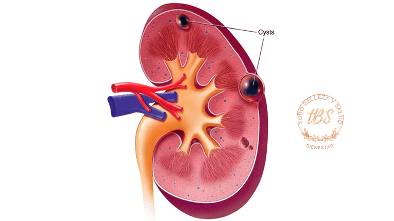 Qué son los Quistes Renales
