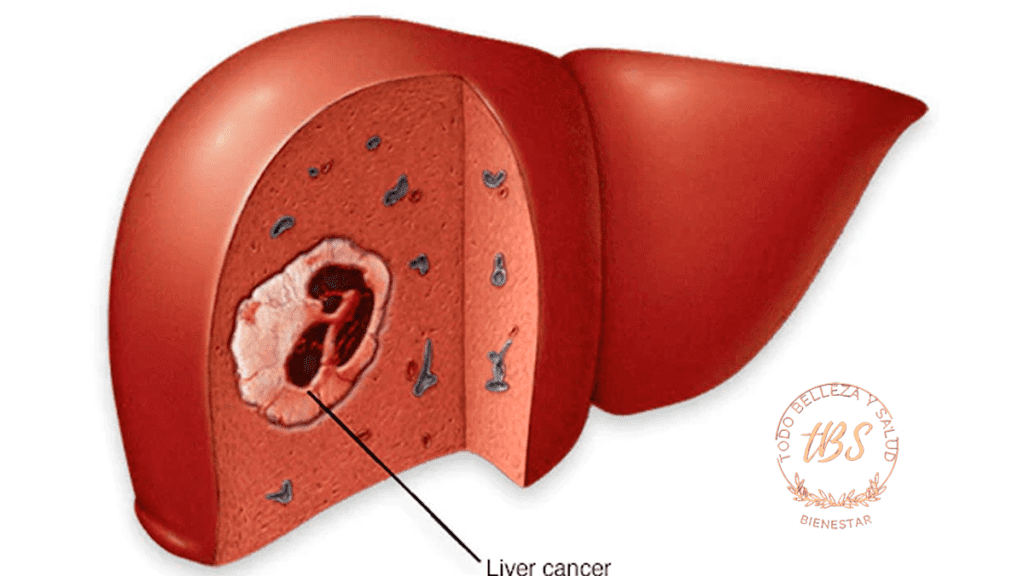 Cáncer de Hígado