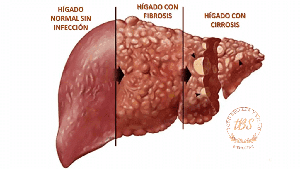 Cirrosis Alcohólica