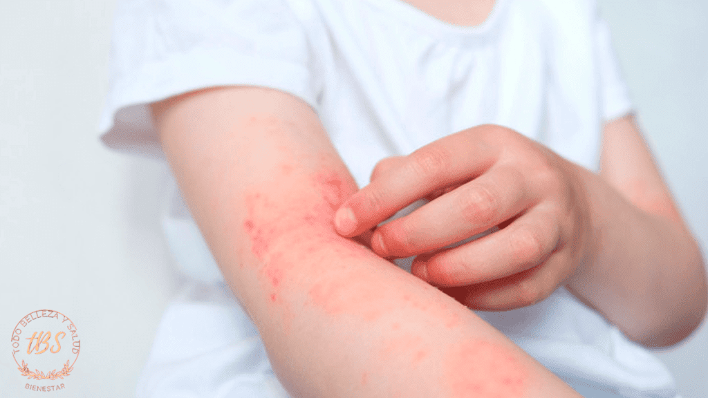 Dermatitis Atópica (Eczema)