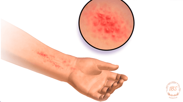 Dermatitis Atópica (Eczema)