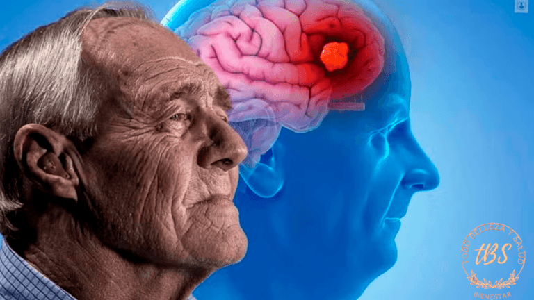 Qué es el Alzheimer