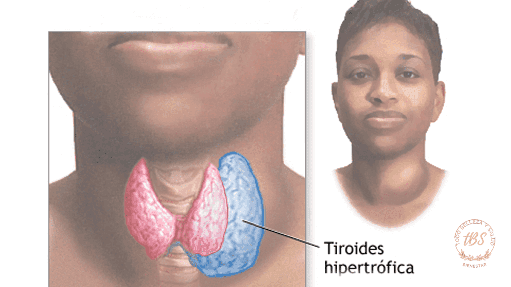 Qué es el hipertiroidismo