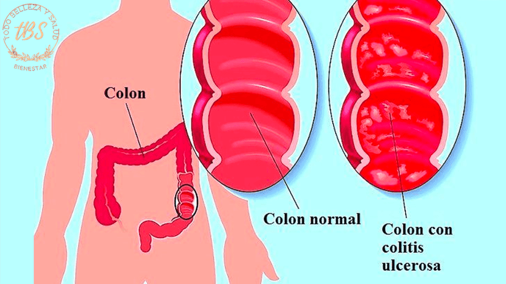 Qué es la Colitis