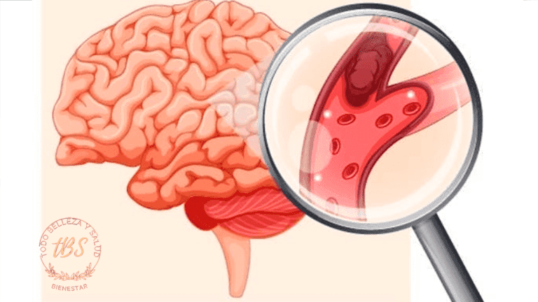 Qué es un ACV Isquémico
