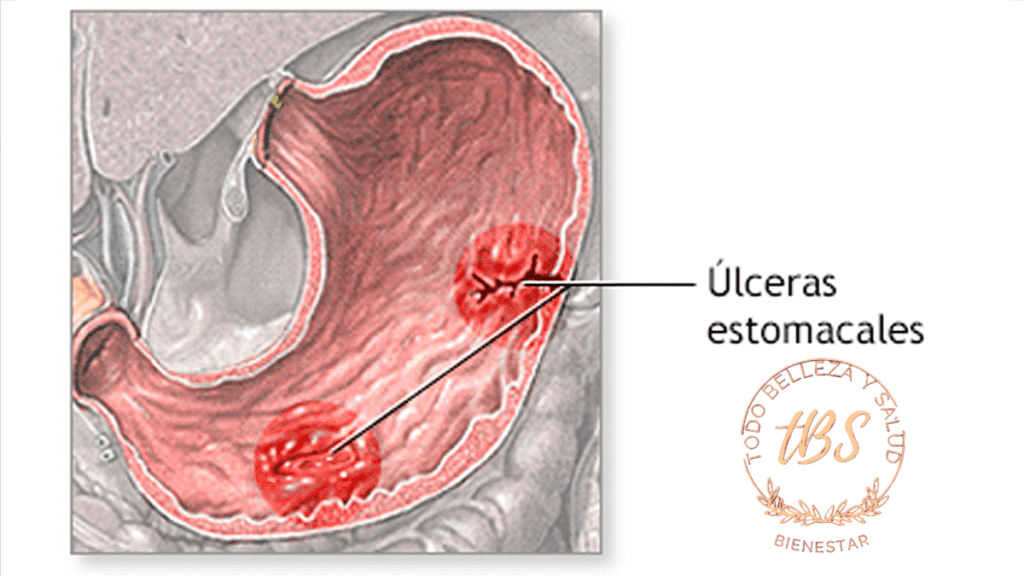 Qué es una Úlcera Estomacal