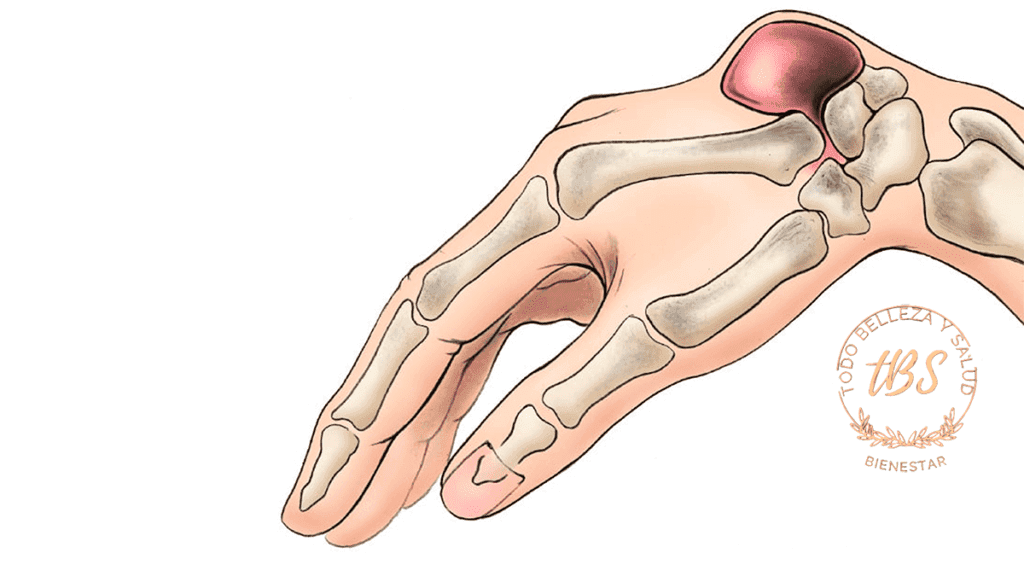Qué son los Quistes Sinoviales