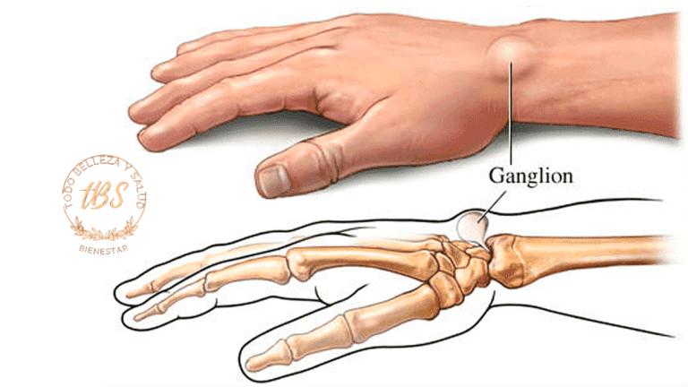 Qué son los Quistes Sinoviales