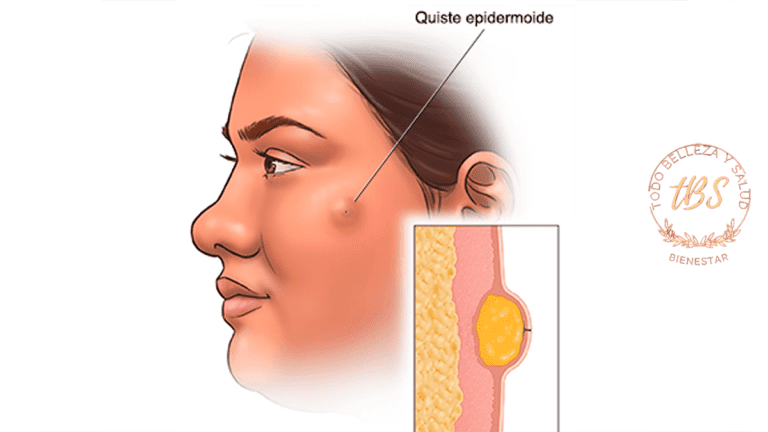 Qué son los quistes epidérmicos