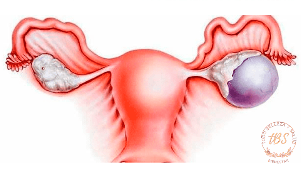 Qué son los quistes ováricos
