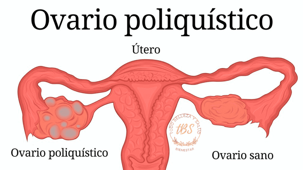 Qué es el Síndrome de Ovario Poliquístico (SOP)