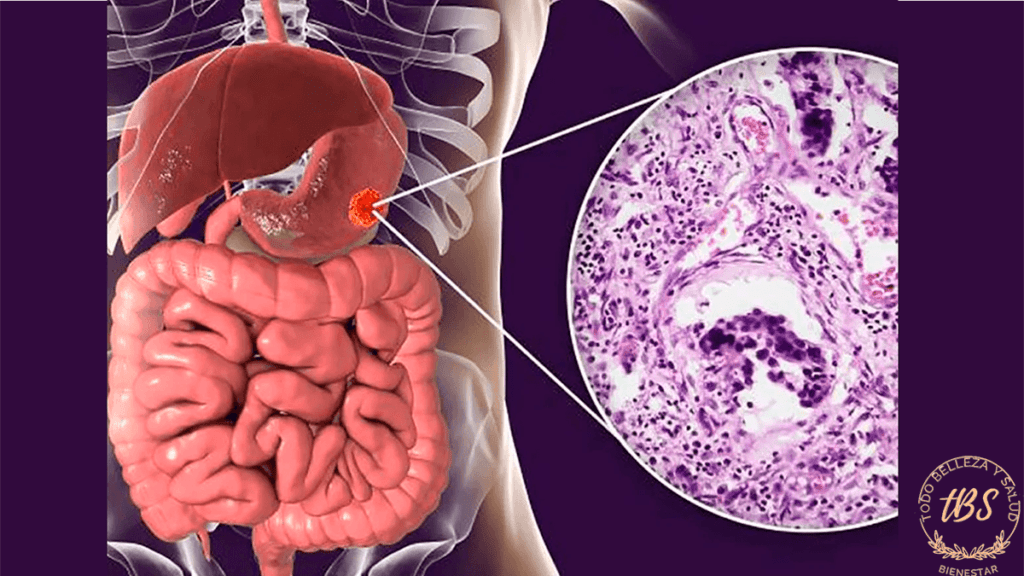 Qué es un Adenocarcinoma